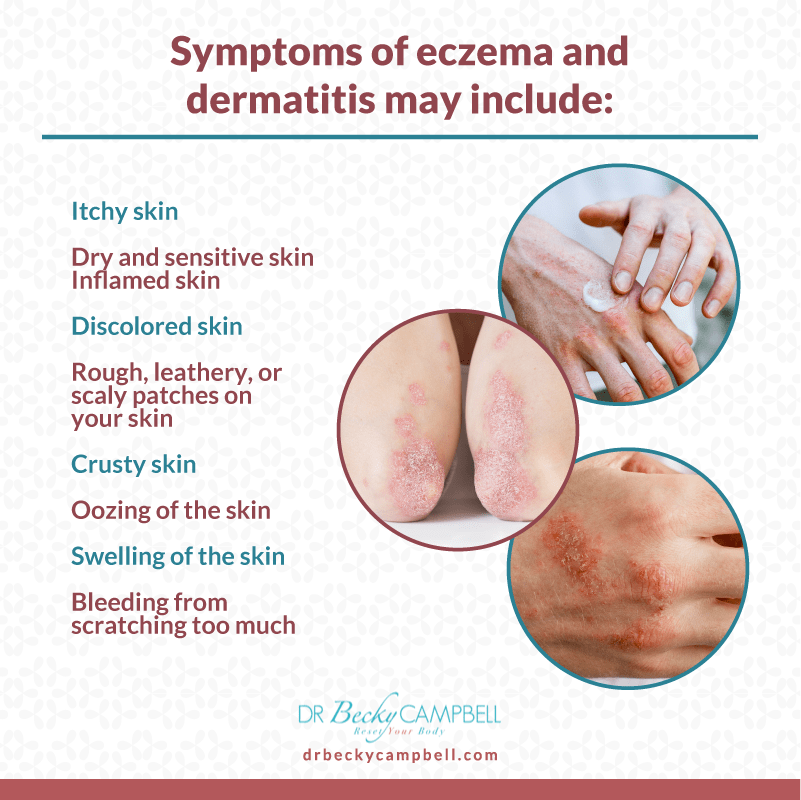 symptoms of eczema and dermatis related to histamine intolerance